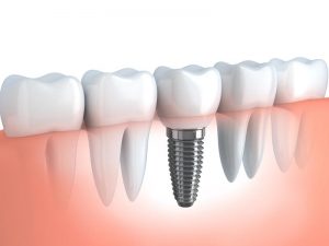 Dental Implants Westborough, MA