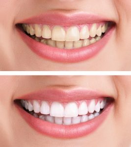 Teeth Whitening Westborough, MA