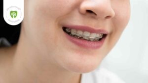 wrap around retainers