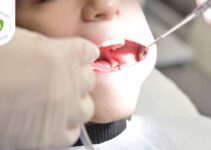 pain relief for braces