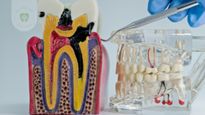 What Is Root Resorption And How Can It Be Dealt With?